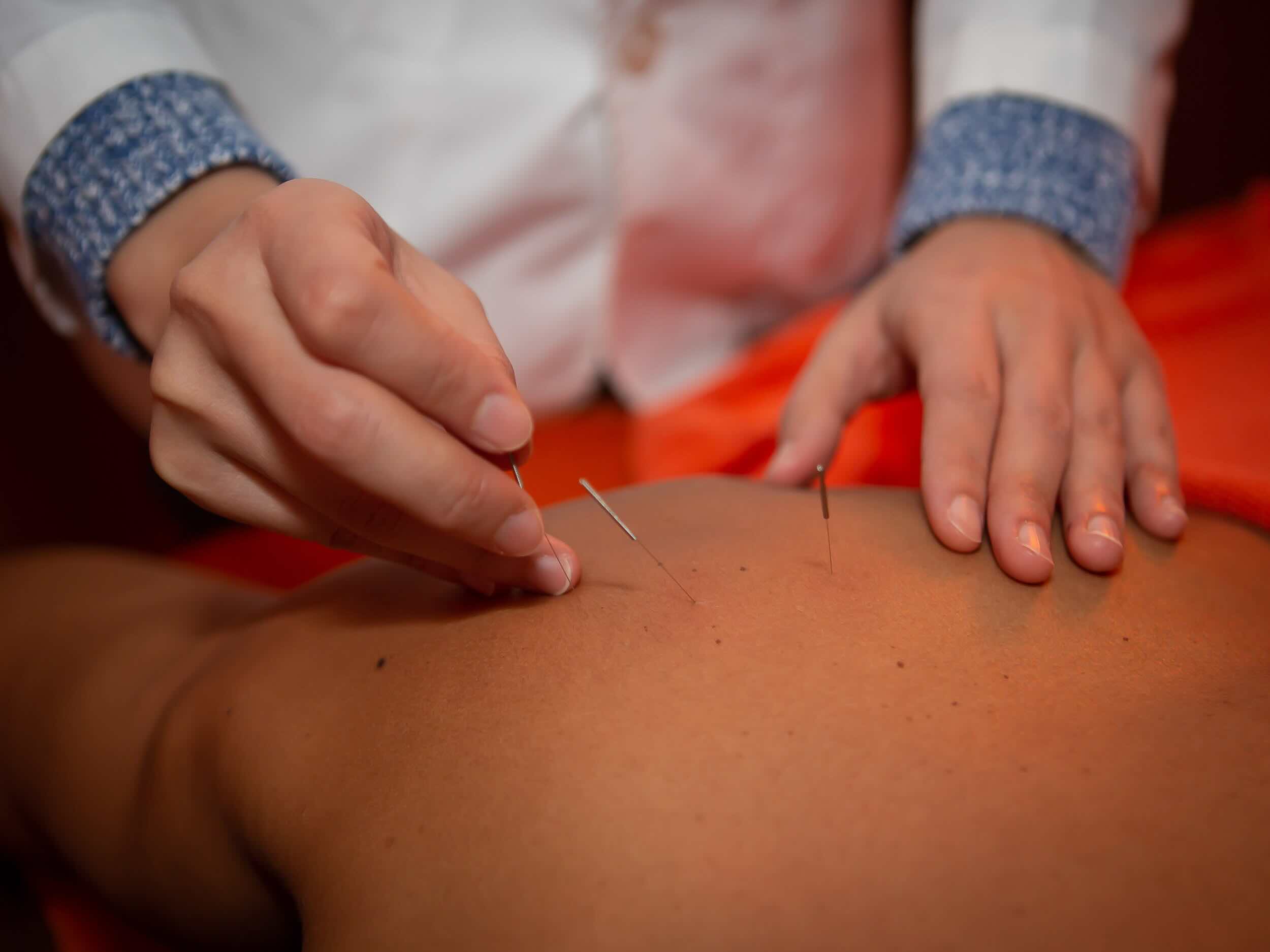 Acupuncture to Quit Smoking: A Natural and Effective Solution